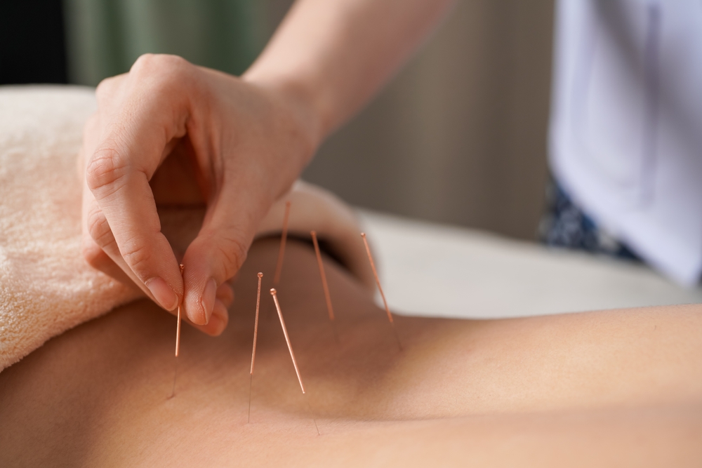 How Acupuncture Can Relieve Chronic Pain: Expert Insights from Tripoint Acupuncture Plus
