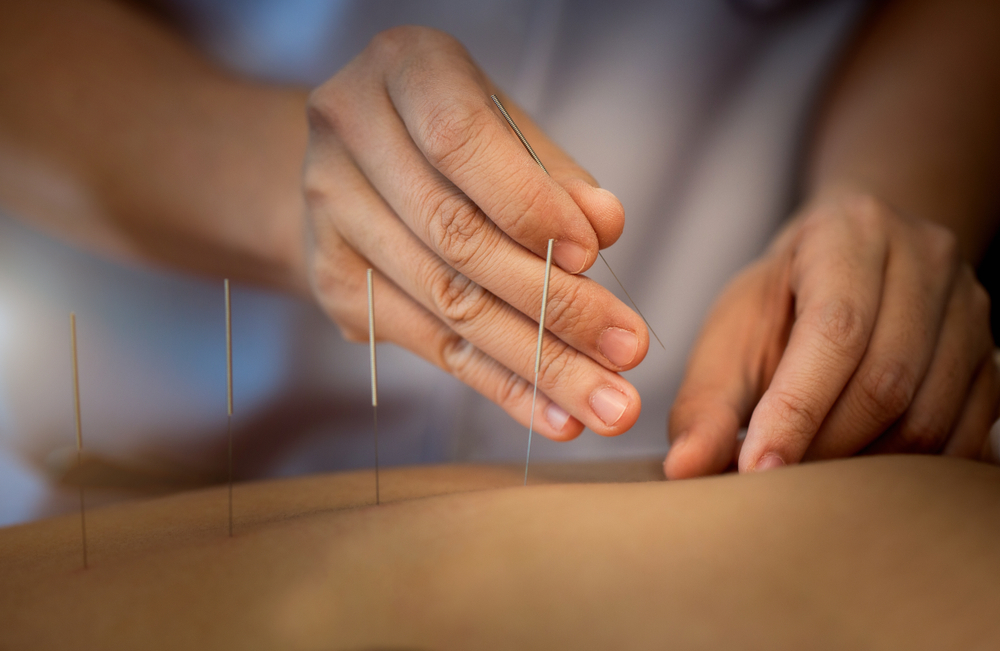 Acupuncture.close Up,of,a,person,getting,an,acupuncture,treatment